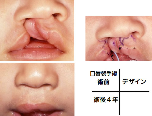 口蓋 裂 口唇