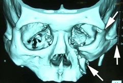頬骨骨折３次元ＣＴ像