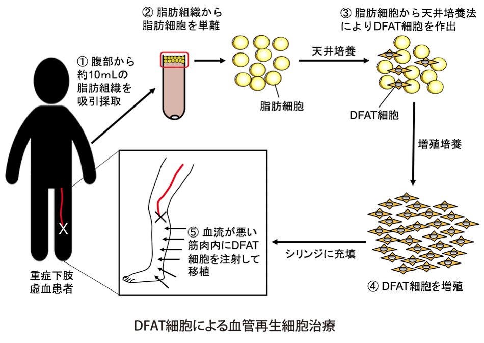 DFAT細胞による血管再生細胞治療