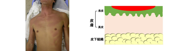 I度熱傷