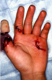 左母指(おやゆび)の切断