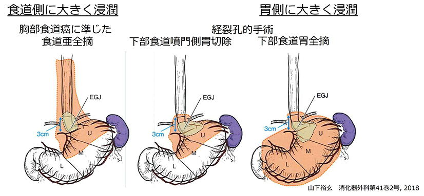 接合部癌