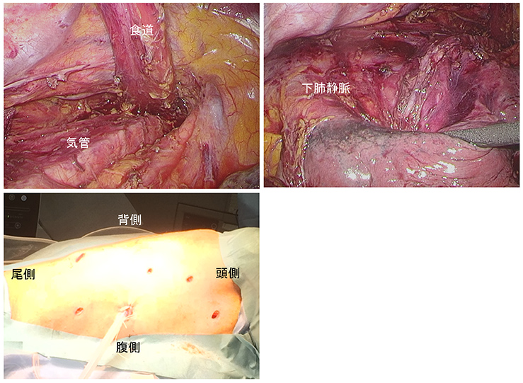 胸腔鏡手術（術中画像、創部）