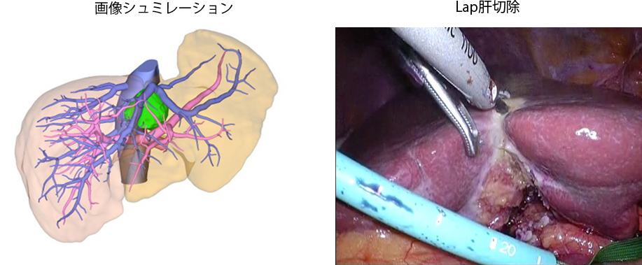 肝切除