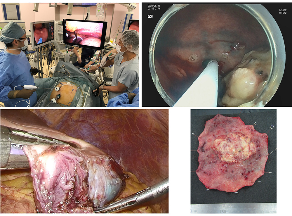 高齢者胃癌に対する腹腔鏡内視鏡合同手術（LECS）（CLEAN-NET）