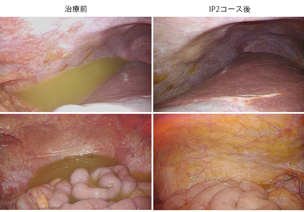 腹腔内化学療法(IP療法)